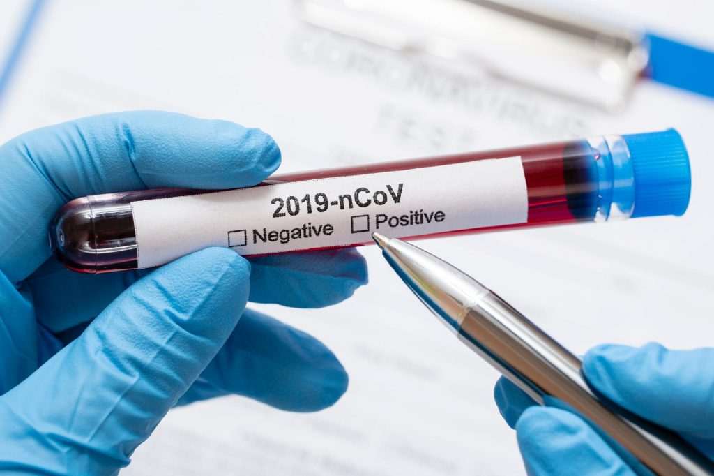 teste-novo-coronavirus-1583536024256_v2_1920x1279